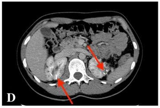 CECT scan shows previous ablation areas