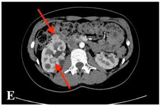 CECT scan shows growing kidney tumours &ndash; four enlarging tumours in the kidneys were found: one in the left kidney and three in the right one