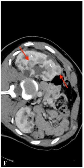 CECT scan before cryoablation of three tumours of the right kidney