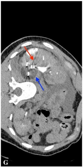CECT scan during cryoablation: the monitored ablation probe (red arrow) and a tumour-containing &ldquo;ice bubble&rdquo; (blue arrow)