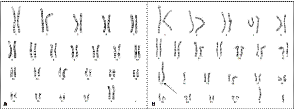 Normal female karyotype (A), male karyotype with Robertsonian translocation (indicated by arrow) (B).