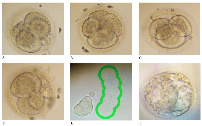 Embryo development and blastomere biopsy. A &ndash; 3 day embryo No 1, 4 cell stage; B &ndash; 3 day embryo No 2, 6 cell stage; C &ndash; 3 day embryo No 3, 3 cell stage; D 3 day embryo No 4, 4-5 cell stage; E &ndash; laser assisted single blastomere biopsy; F &ndash; 5 day poor quality blastocyst from embryo No 2 transferred to the uterus.