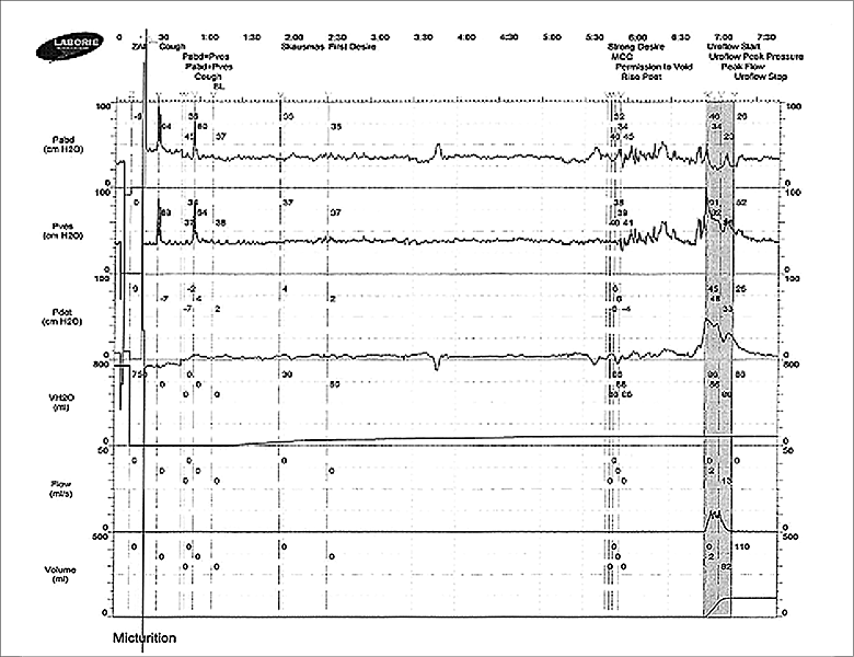 Pacientės cistometrijos rezultatai (VUL Santaros klinikų Urologijos centras)