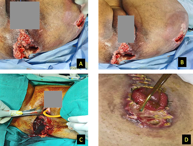 A – Devastating perineal wound; B – Area of skin necrosis seen over left gluteal region; C – Perineal tear extending to Vagina; D – Temporary diverting loop colostomy