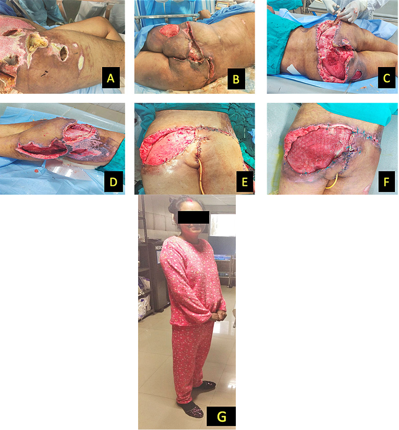 A – Necrotic right flank wound; B – Area of skin necrosis seen over bilateral gluteal region; C – Post debridement of necrotic gluteal skin; D – Right flank wound post debridement; E – reconstruction of neo anal opening using rotation flap from left gluteal region; F – residual wound pos Negative pressure wound therapy; G – Patient after 3 months of hospitalization ambulant without support