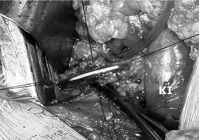 Kairiojo šlapimtakio plastika, operacinis vaizdas (KI &ndash; kairysis inkstas)