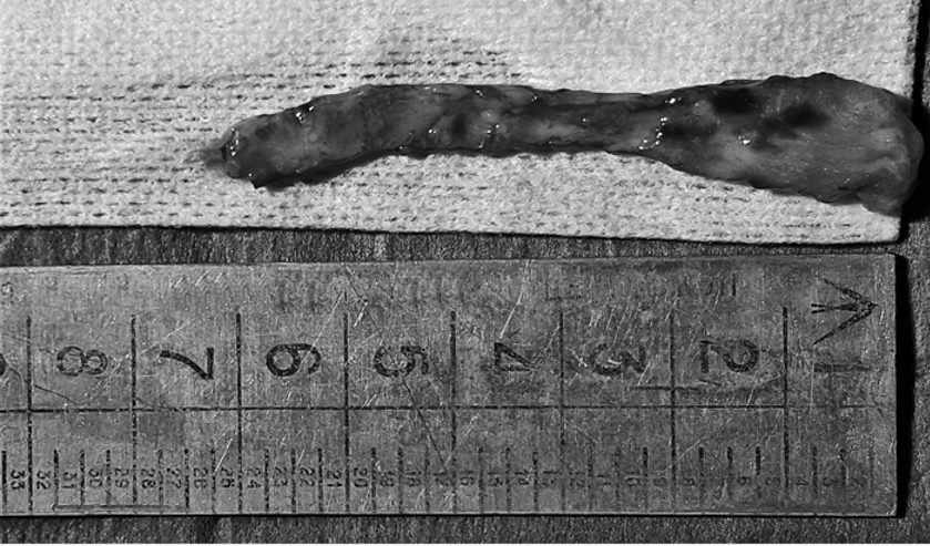 Burnos gleivinės lopas