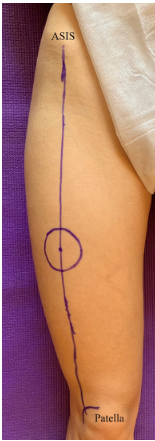 Tiriamosios srities žymėjimas (ASIS – priekinis viršutinis klubakaulio dyglys)