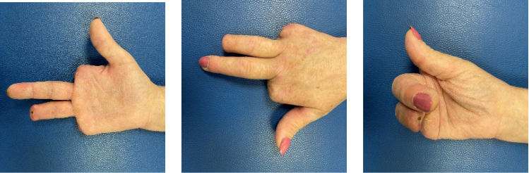 It should be noted that the distal thirds of the II and V metacarpals were not removed during the operation, but the patient is satisfied with the functional state – it is comfortable to grip a pen