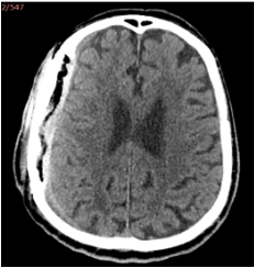Po  šeštosios  operacijos  (teigia-mi  pooperaciniai  pakitimai,  smarkiai  sustorėjęs  kietasis  smegenų  dangalas,  tarpas  tarp  kaulo  ir  kietojo  smegenų  dangalo; VSD nėra)