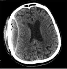 Bėgant laikui, padidėjusi EDS (dešinėje F-T-P, padidėjusi VSD į kai-rę iki 4 mm)