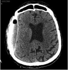 Implantavus  vakuuminę  sis-temą  su  PVK  (dešinė  F-T-P  EDS  di-namikoje  sumažėjusi;  išlieka  nežymi  VSD)
