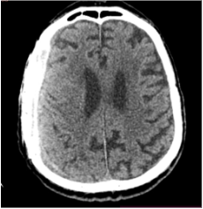 Dešinė F-T-P EDS dinamiko-je sumažėjusi (VSD nematyti)