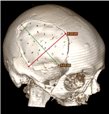 Kranioplastikos lopo dydis (iki 75 cm2)