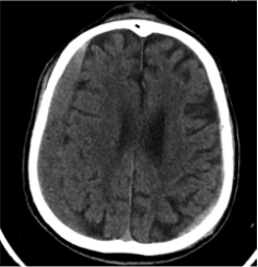 Prieš  pirmąją  operaciją  (poū-mė,  stambi,  iki  16  mm  SDH  apie  dešinįjį pusrutulį, ūmi nedidelė SDH kairėje F-P; VSD į kairę ~3 mm)