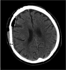 Po  pirmosios  operacijos  (di-džioji   hematomos   dalis   pašalinta,   VSD be dislokacijos)