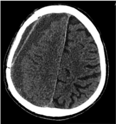 Prieš antrąją operaciją (25 mm storio hipodencinė juosta virš dešinio-jo  smegenų  pusrutulio,  esant  8  mm  dislokacijai  į  kairę;  įtarta  lėtinė  SDH  dešinėje)