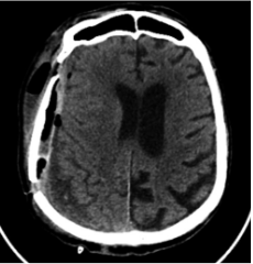 Po antrosios operacijos (didžio-ji  hematomos  dalis  pašalinta;  VSD  sumažėjo nuo 8 iki 5 mm)