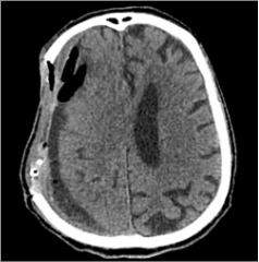 Po  trečiosios  operacijos  (di-džioji hematomos dalis pašalinta, nu-statyta  empiema,  oro  intarpų,  VSD  sumažėjo nuo 6 mm iki 4 mm)