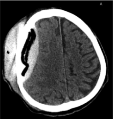 Po   ketvirtosios   operacijos   (kranioplastikos)  (kraniolopo  padėtis  gera;  po  kraniolopu  ūminė  EDH  su  hemostatine medžiaga, VSD į kairę – iki 3 mm; dešinėje – poodyje poope-racinė sankaupa su pakraujavimu)