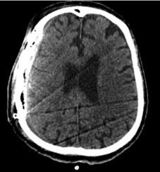 Po  penktosios  operacijos  (epi-durinė ir periostinė hematomos paša-lintos; VSD nėra)