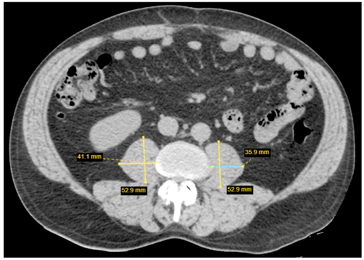 Musculus psoas ploto matavimas L3 stuburo slankstelio lygyje, atliekant KT