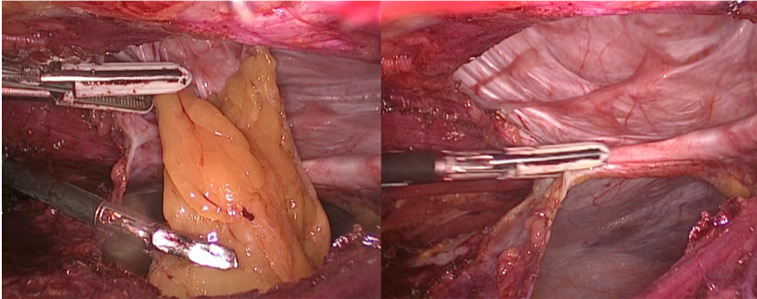 Adhesiolysis of greater omentum and transection of the hernial sac