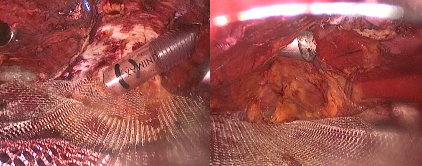 Placement of a large mesh without fixation