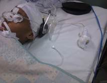 Neuromonitorizaci&oacute;n continua de la PIC en un ni&ntilde;o con TCE grave