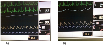 Representaci&oacute;n gr&aacute;fica de la monitorizaci&oacute;n continua de la PIC en UCIP.