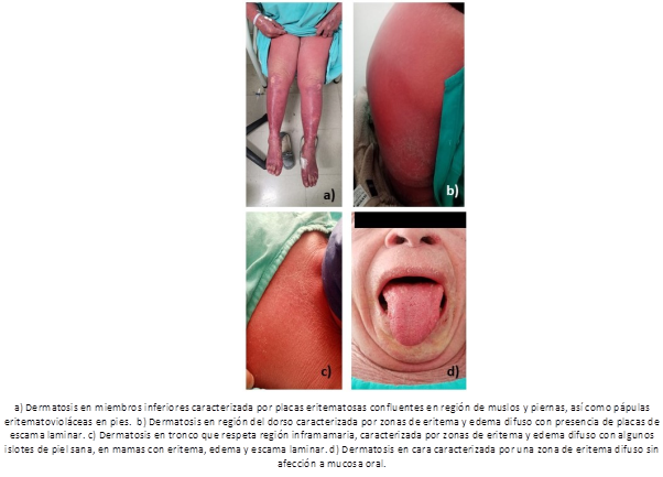 Hallazgos a la exploraci&oacute;n f&iacute;sica sugerente de eritrodermia.