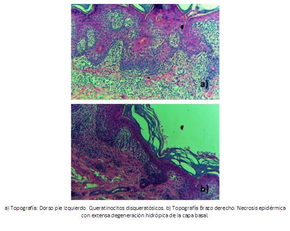 R biopsias de mapeo de la piel con tinci&oacute;n de hematoxilina-eosina.