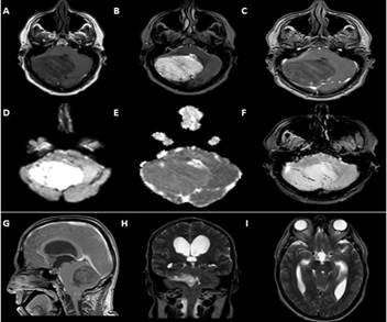 Imágenes convencionales de resonancia magnética.