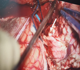 Acto quirúrgico. La flecha señala las folias cerebelosas derechas engrosadas.