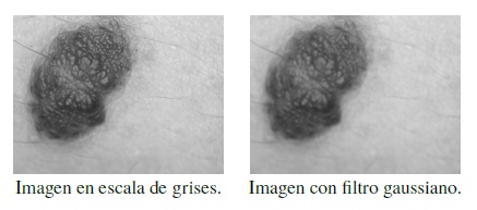 Aplicaci&oacute;n de filtro gaussiano a nevus compuesto.