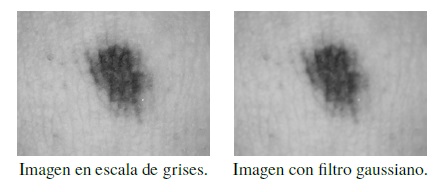 Aplicaci&oacute;n de filtro gaussiano a nevus displ&aacute;sico.
