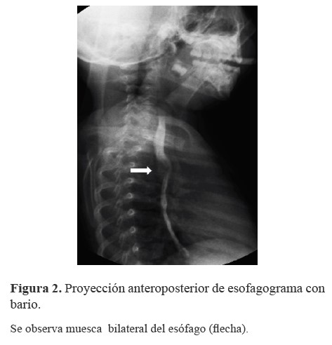 Proyección anteroposterior de esofagograma con bario