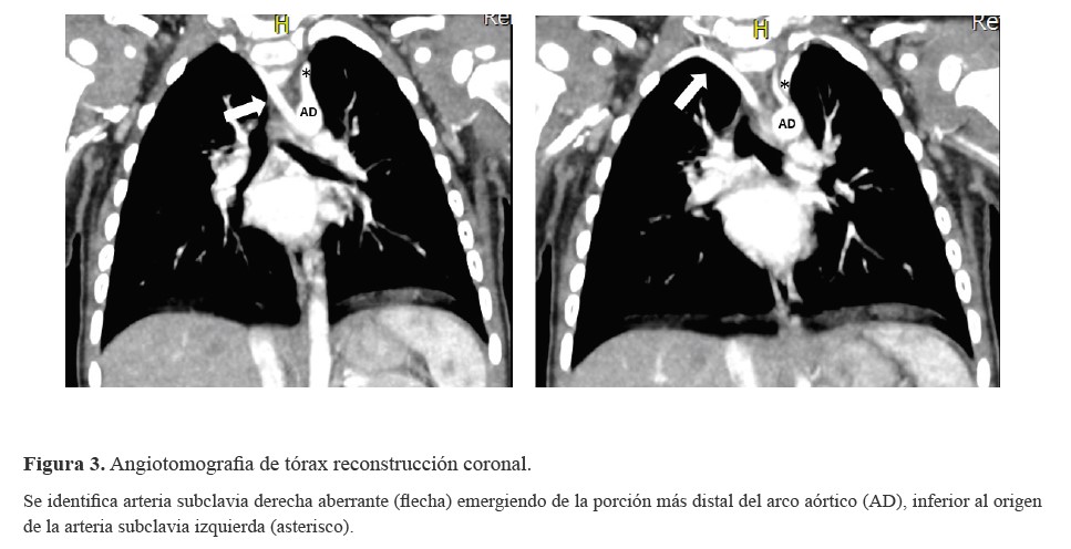 Angiotomografia de tórax reconstrucción coronal