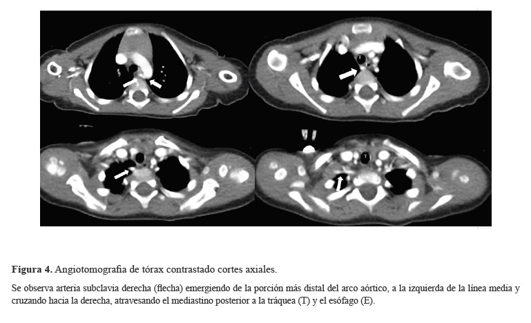 Angiotomografia de tórax contrastado cortes axiales
