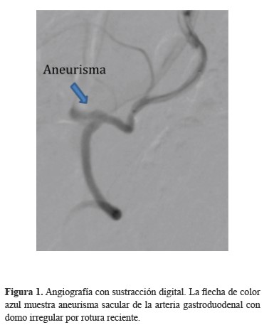 Angiograf&iacute;a con sustracci&oacute;n digital. La flecha de color azul muestra aneurisma sacular de la arteria gastroduodenal con domo irregular por rotura reciente.