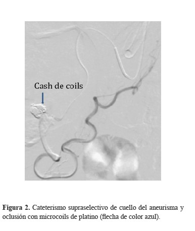 Cateterismo supraselectivo de cuello del aneurisma y oclusi&oacute;n con microcoils de platino flecha de color azul