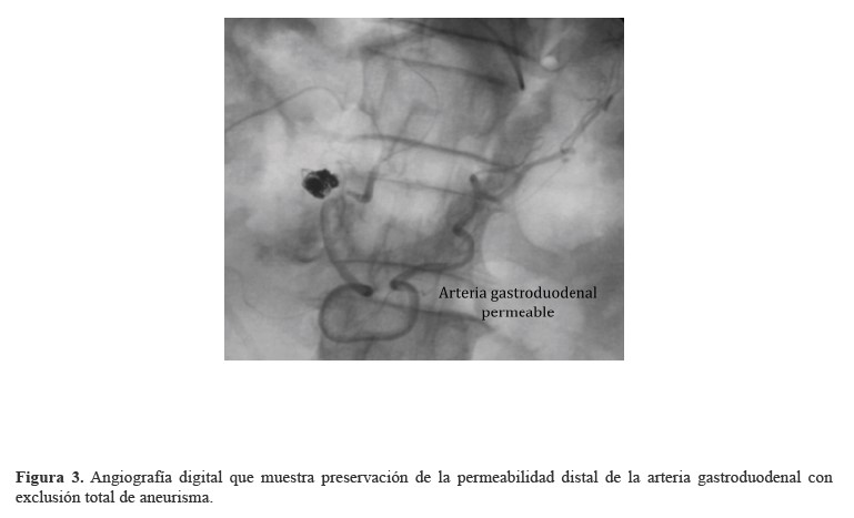 Angiograf&iacute;a digital que muestra preservaci&oacute;n de la permeabilidad distal de la arteria gastroduodenal con exclusi&oacute;n total de aneurisma