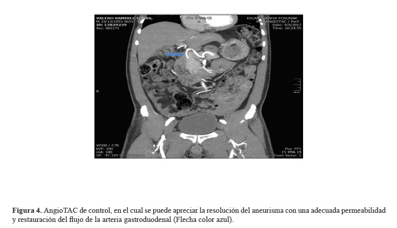 AngioTAC de control, en el cual se puede apreciar la resoluci&oacute;n del aneurisma con una adecuada permeabilidad y restauraci&oacute;n del flujo de la arteria gastroduodenal (Flecha color azul)