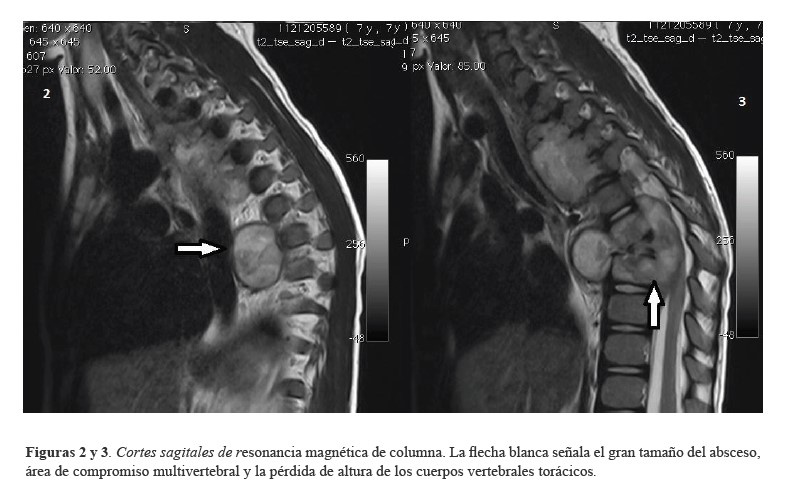 Cortes sagitales de resonancia magn&eacute;tica de columna. La flecha blanca se&ntilde;ala el gran tama&ntilde;o del absceso, &aacute;rea de compromiso multivertebral y la p&eacute;rdida de altura de los cuerpos vertebrales tor&aacute;cicos.