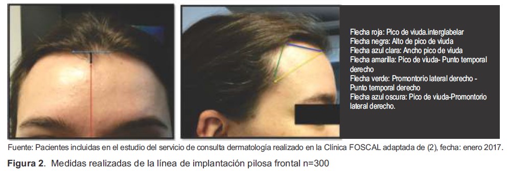 Medidas realizadas de la l&iacute;nea de implantaci&oacute;n pilosa frontal n300