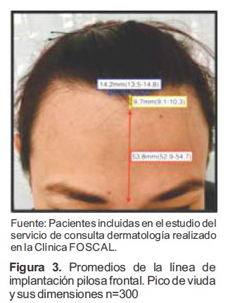Promedios de la l&iacute;nea de implantaci&oacute;n pilosa frontal Pico de viuda y sus dimensiones n300