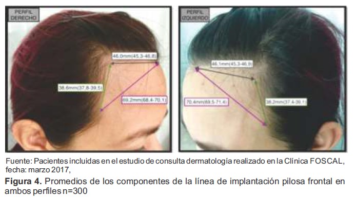 Promedios de los componentes de la l&iacute;nea de implantaci&oacute;n pilosa frontal en ambos perfiles n300