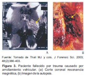 Paciente fallecido por trauma causado por arrollamiento vehicular. (a) Corte coronal resonancia magnética, (b) Imagen de la autopsia.