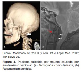 Paciente fallecido por trauma causado por arrollamiento vehicular. (a) Tomografía computarizada, (b) Resonancia magnética.