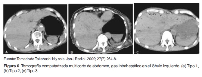 Tomografía computarizada multicorte de abdomen, gas intrahepático en el lóbulo izquierdo. (a) Tipo 1, (b) Tipo 2, (c) Tipo 3.